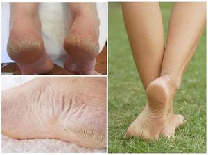 Грибок на пятках (микоз): причины появления, как возникают симптомы, лечение мазью и др