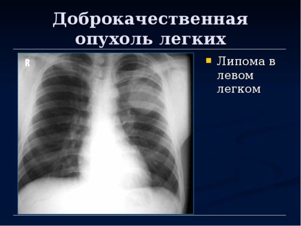 Липома: что это такое, причины возникновения, симптомы, методы терапии 6