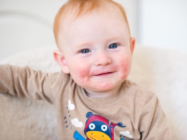 Что такое атопия: причины, симптомы, лечение у детей 4