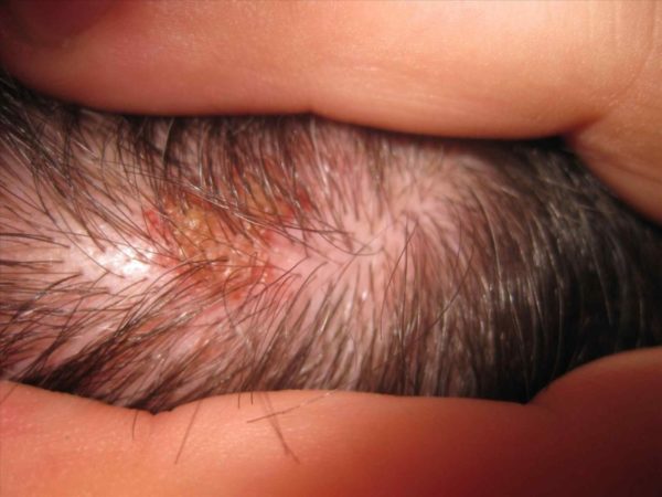 Лишай на голове: причины патологии, симптомы, методы терапии в домашних условиях6