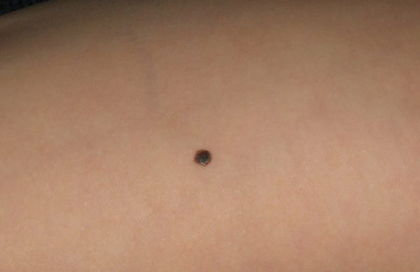 Невус: что это такое, причины образования, виды, симптомы возрождения 12