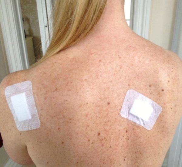 Воспаленная папиллома: причины воспаления, что делать 4