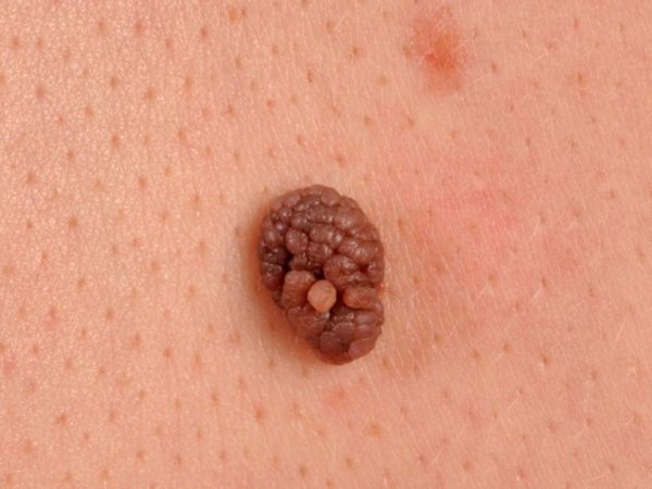 Невус: что это такое, причины образования, виды, симптомы возрождения 11