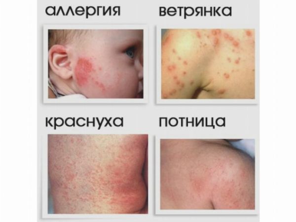 Как отличить ветрянку от аллергии и других подобных заболеваний: отличия
