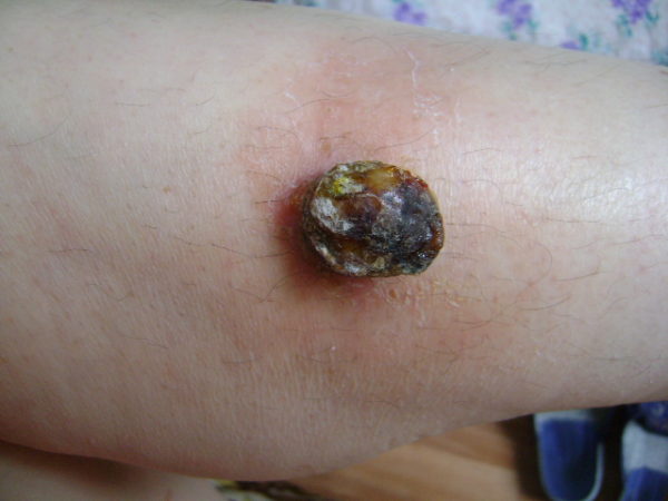 Упал крот: причины, первая помощь, методы лечения