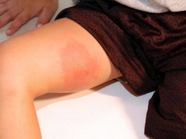 Зуд внутренней поверхности бедра у женщин: причина события, к какому врачу обратиться 3