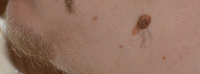 Что делать, если вы разрезали родинку бритвой или острым предметом: как остановить кровотечение, к какому врачу обратиться