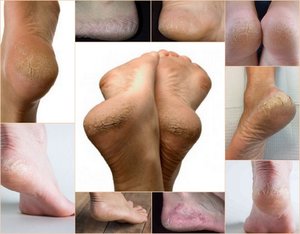 Грибок на пятках (микоз): причины появления, как проявляются симптомы, лечение мазью и многое другое1