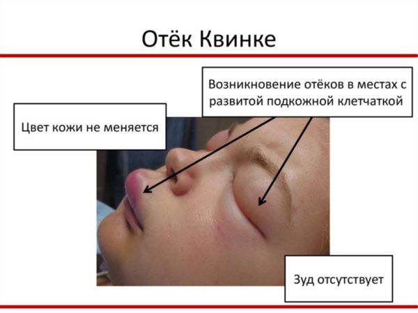Диета при отеке Квинке: что можно есть при обострениях, после болезни