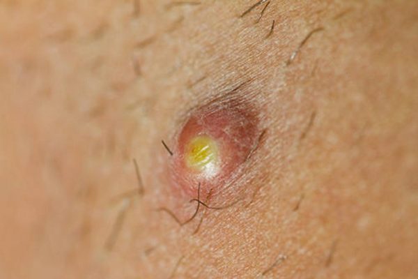 Антибиотики при фурункулезе: как лечить гнойные образования 2