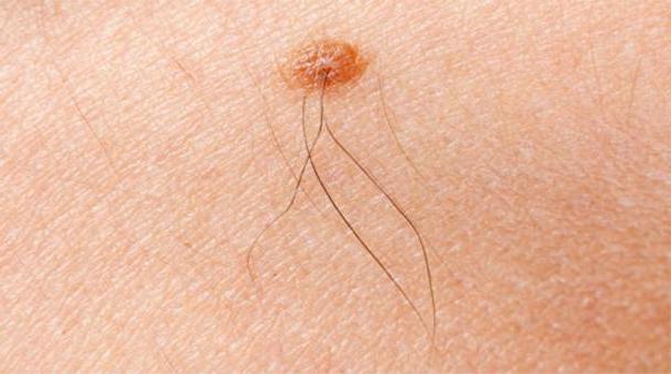 из родинки можно выдергивать волосы 0