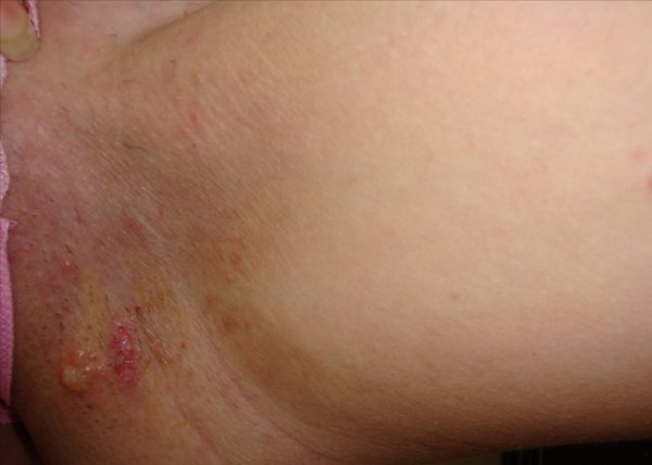 Зуд в промежности у мужчин и женщин: причины появления, как лечить в домашних условиях 4