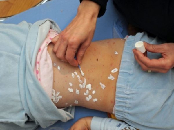 Лосьон Каламин от ветрянки у детей - отличие от аналогов4