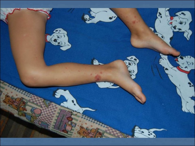 Почему синяки появляются на теле от легкого прикосновения и без ударов1