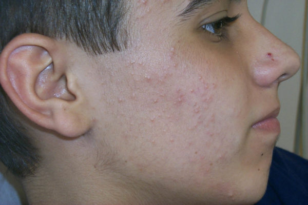 Хозяйственное мыло от прыщей: как пользоваться, домашние рецепты