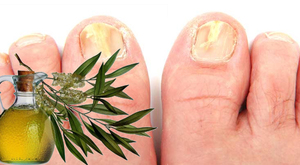Масло от грибка ногтей: действие, особенности использования натурального противогрибкового средства8