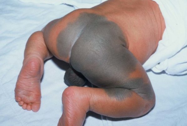 Виды родинок у человека: доброкачественные и злокачественные 10