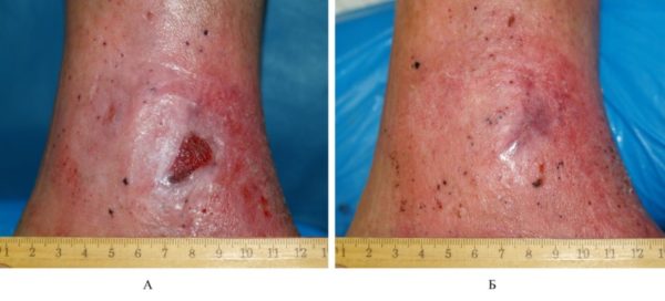 Трофическая язва на ноге: лечение мазями и как ими пользоваться 2