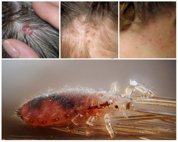 Вши живут на окрашенных волосах, краска убивает паразитов