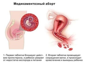 Прерывание беременности с использованием мифепрестона Прерывание беременности с помощью мифепрестона