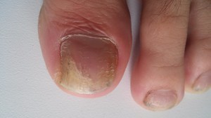 Симптомы грибка ногтей на ногах: первые признаки, особенности проявления различных форм болезни