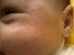 Что делать если у ребёнка аллергия зелёнку Как быть, когда у ребёнка аллергия на зелёнку