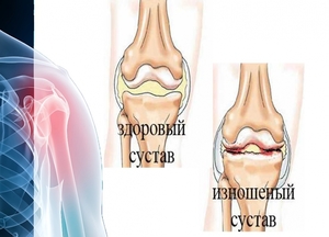 Артрит Причины возникновения артрита
