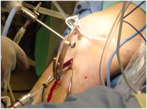 Артроскопия коленного сустава при болезни Гоффа Артроскопия коленного сустава - показания к назначению