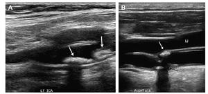 Атеросклеротические бляшки в сосудах шеи Бляшка в сосуде шеи