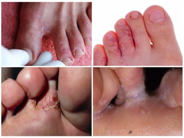 Грибок между пальцами: признаки, причины развития, профилактика, медикаментозная терапия 3