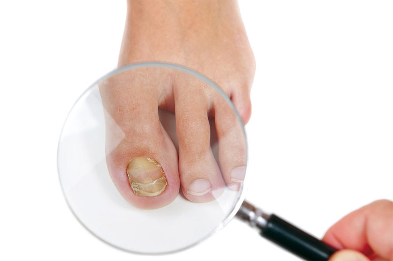 Способы избавления от грибка на ногах народными средствами: рецепты, помогающие в борьбе с недугом