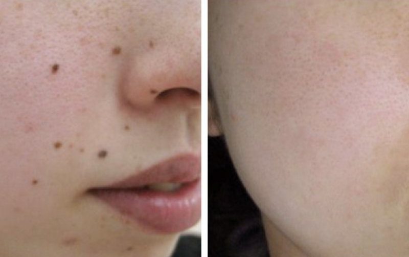 Рубец после удаления родинки: какие шрамы остаются после операции, как удалить их лазером, мази