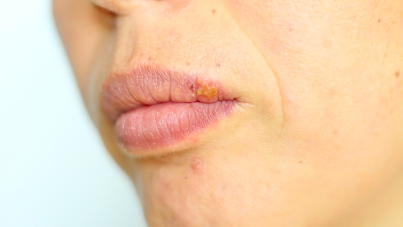 Радиоволновой метод удаления родинок: какие аппараты используются для процедуры, как выглядит невус после операции 2