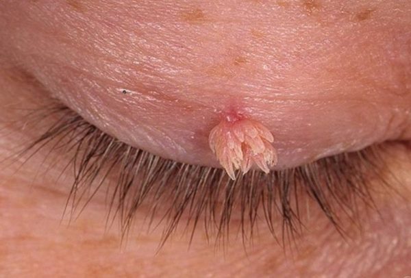 Висячие папилломы: причины появления и как их удалить в домашних условиях