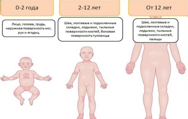 Острая жара у детей: причины, признаки, терапия 6