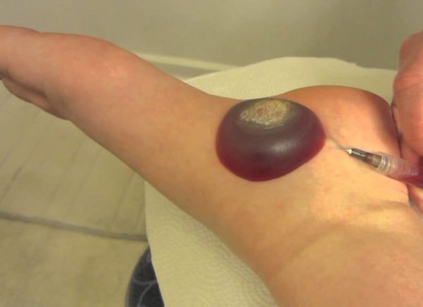 Удаление бородавок лазером или азотом: что лучше, сравнение методов9