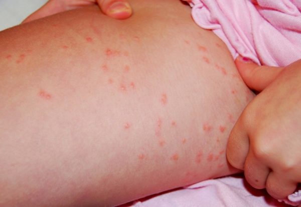 Как понять, что у вас вши, как отличить гниды от перхоти 3