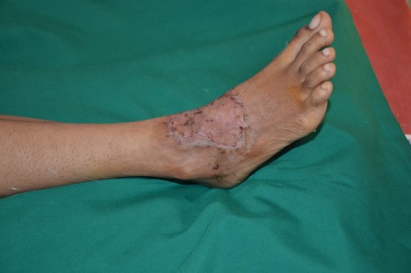 Витилиго: народное лечение, причины, симптомы 5