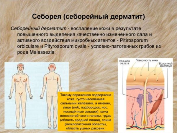Какая мазь от себорейного дерматита быстро снимает шелушение и покраснение