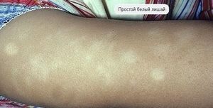 Лечение белого лишая чем лечить белый лишай
