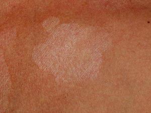 Кто наиболее подвержен риску заболеть лишаем лечение белого лишая у ребенка