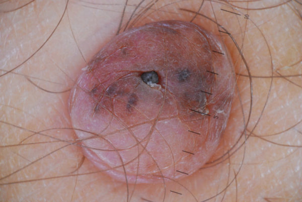 Невус: что это такое, причины образования, виды, симптомы возрождения6