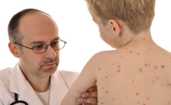 Диарея при ветрянке у детей: когда возникает диарея