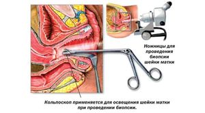 Показания к биопсии при эрозии шейки матки Показания к биопсии при эрозии шейки