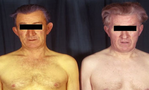 Бледность кожных покровов Бледность кожных покровов при панреатите