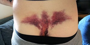 Ушиб копчика Боль в копчике из-за ушиба