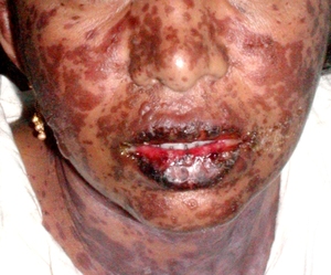 Что такое болезнь Лайелла Почему может появиться болезнь Лайелла