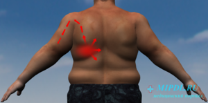 Проекция иррадиации стенокардиальной боли (вид сзади) Проекция иррадиации стенокардиальной боли