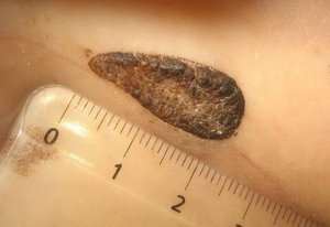 Папилломатозный невус при беременности Особенности лечения невусов