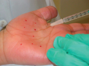 Ботокс при гипергидрозе С помощью инъекций ботокса вы забудете о проблеме гипергидроза надолго